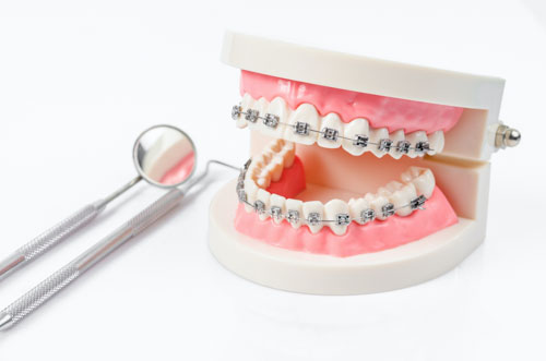 Tư vấn phương pháp niềng răng phù hợp với tình trạng răng cụ thể