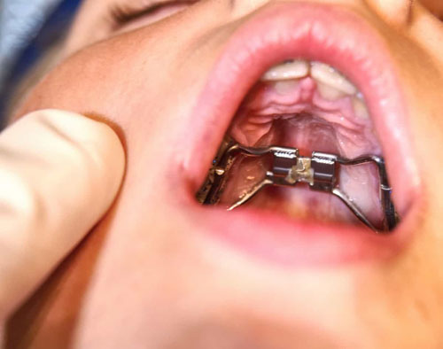 Vòm hàm quá hẹp sẽ cần nong hàm khi niềng răng