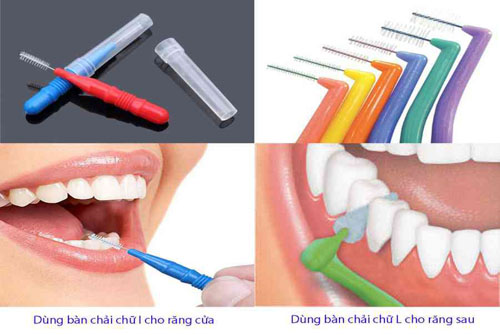 Bàn chải kẽ là dụng cụ làm sạch răng miệng không thể thiếu khi niềng răng