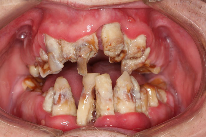 Các bệnh lý ở răng vô cùng nguy hiểm nếu không khắc phục sớm
