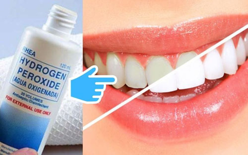 Cách làm trắng răng bằng oxy già chỉ nên áp dụng 1 lần/tuần