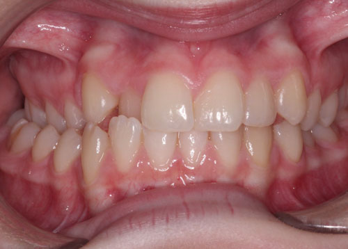 Cắn chéo răng sau biểu hiện là răng cối hàm trên nằm ở trong hoặc ở ngoài răng cối hàm dưới