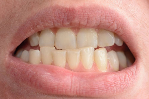 Cắn chéo răng trước biểu hiện bằng việc răng cửa hàm trên nằm bên trong răng cửa hàm dưới