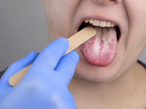 Chẩn đoán bệnh nấm miệng bằng cách kiểm tra những tổn thương trong khoang miệng