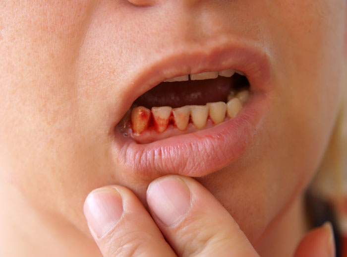 Chảy máu kéo dài là một trong những biến chứng của nhổ răng khôn mọc ngầm