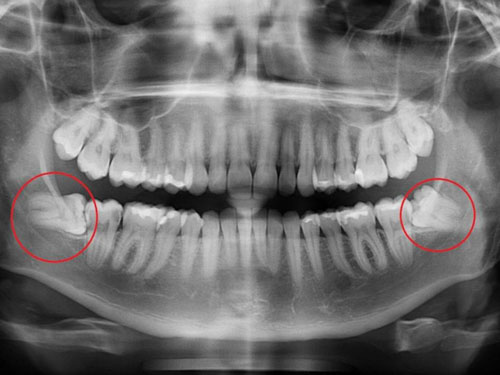 Chụp X quang rất cần thiết trong các trường hợp mọc răng khôn