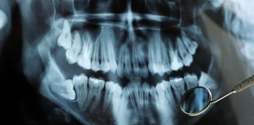 Chụp X quang vòng quanh răng