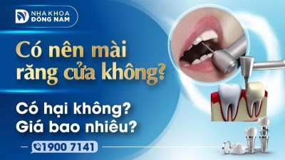 Có nên mài răng cửa không? Có hại không Giá bao nhiêu?