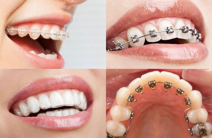 Có nhiều phương pháp niềng răng lệch khớp cắn để lựa chọn