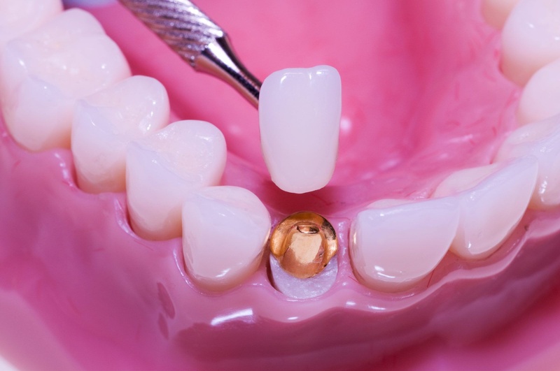 Cùi răng giả là cấu trúc mô phòng cùi răng thật