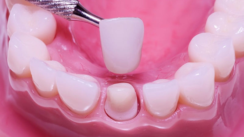 Cùi răng là phần răng thật còn lại sau khi được mài chỉnh để làm trụ nâng đỡ