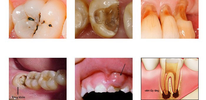 Đau răng gây đau đầu có thể do các bệnh lý ở răng miệng