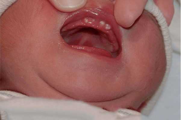 Hình ảnh nanh sữa ở trẻ sơ sinh