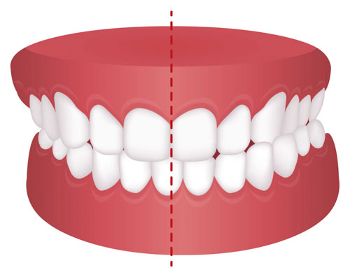 Khớp cắn chéo biểu hiện ở sự không đồng đều giữa các nhóm răng hàm trên và hàm dưới