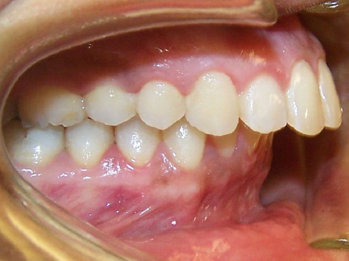 Khớp cắn hô vẩu