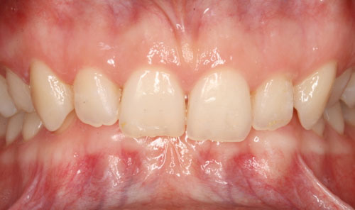 Khớp cắn sâu khiến răng hàm trên bao phủ toàn bộ răng hàm dưới