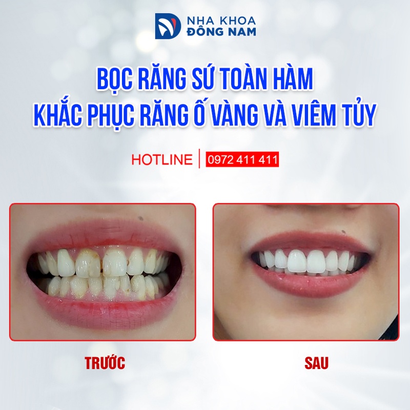 Mài răng bọc sứ cho chiếc răng cửa bị viêm tủy giúp duy trì tuổi thọ của răng được lâu hơn