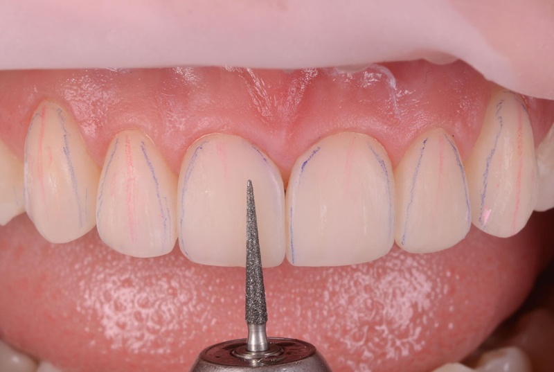 Mài răng là kỹ thuật điều chỉnh lại kích thước của răng