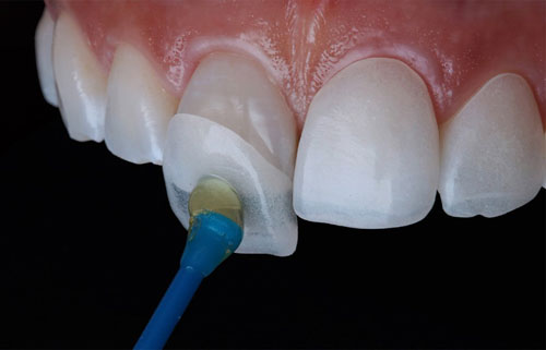 Mài răng thường được áp dụng trong trường hợp làm mặt dán sứ hoặc bọc răng sứ
