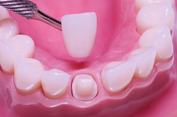 Mài răng thường được chỉ định trong trường hợp bọc răng sứ