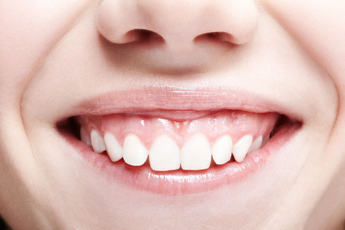 Mài xương ổ răng áp dụng cho tình trạng hô vẩu và cười hở lợi do xương ổ răng dày