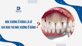 Mài xương ổ răng là gì? Khi nào thì mài xương ổ răng?
