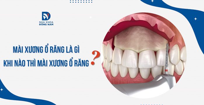 Mài xương ổ răng là gì? Khi nào thì mài xương ổ răng?