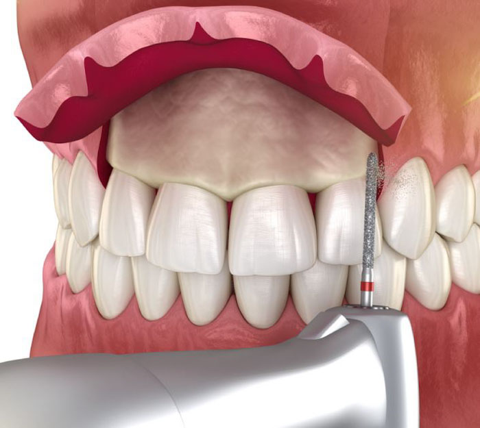 Mài xương ổ răng nhằm mục đích giảm bớt độ dày của xương ổ răng
