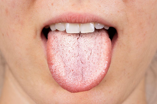 Mảng trắng trong miệng rất có khả năng là dấu hiệu của bệnh nấm miệng