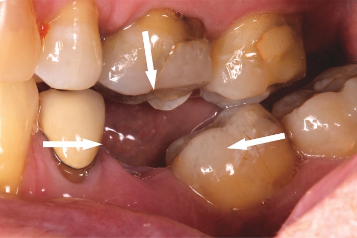 Mất răng gây xô lệch răng còn lại