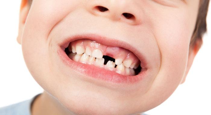 Mất răng sữa sớm là một trong những nguyên nhân dẫn tới răng mọc ngầm