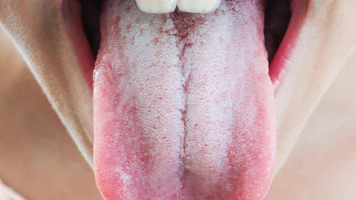 Miệng xuất hiện mảng trắng và thường xuyên có cảm giác đau nhức