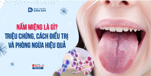 Nấm miệng là gì? Triệu chứng, cách điều trị và phòng ngừa hiệu quả