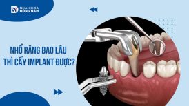 Nhổ răng bao lâu thì cấy Implant được?
