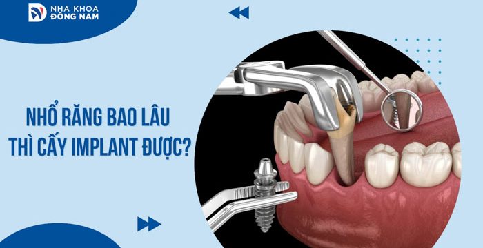 Nhổ răng bao lâu thì cấy Implant được?
