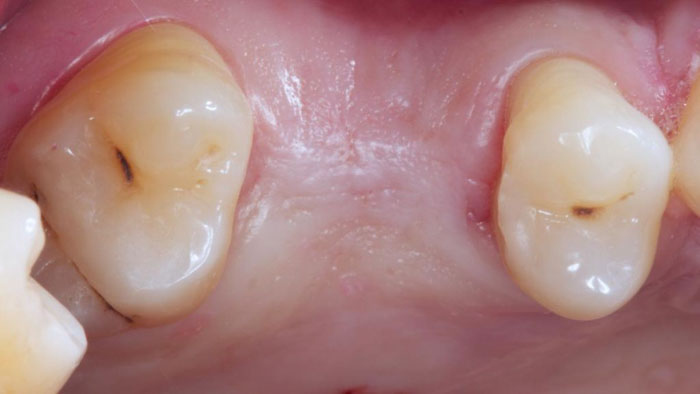 Nhổ răng nếu để lâu sẽ làm xương hàm bị tiêu đi với biểu hiện là nướu teo lại