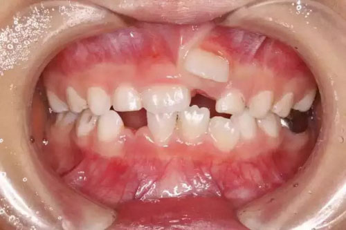 Nhổ răng sữa sớm có thể ảnh hưởng đến hàm răng vĩnh viễn sau này