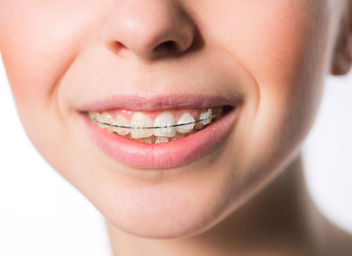 Niềng răng giúp khắc phục tình trạng khớp cắn sâu do răng