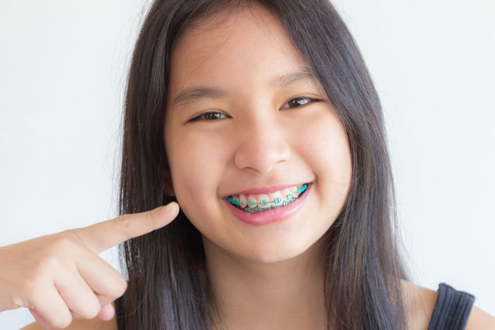Niềng răng là phương pháp nắn chỉnh dịch chuyển răng về vị trí cân đối trên cung hàm