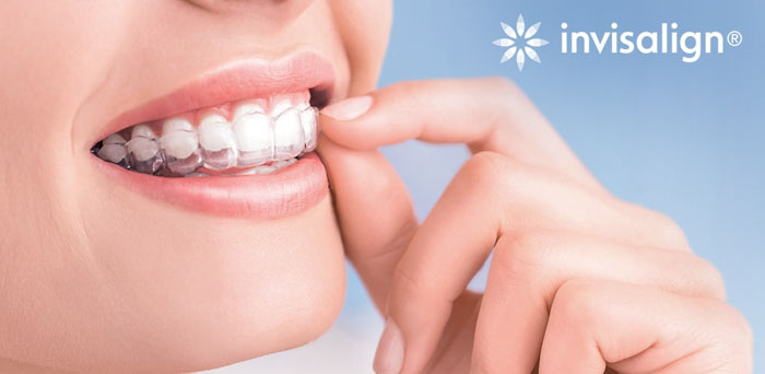 Niềng răng trong suốt chỉ áp dụng hiệu quả cho răng bị sai lệch nhẹ