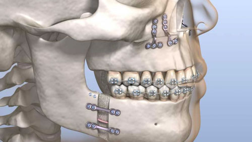 Phẫu thuật hàm kết hợp niềng răng khắc phục khớp cắn sâu