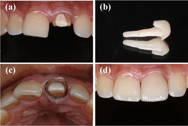 Phục hình mão sứ khi cùi răng đã gắn ổn định