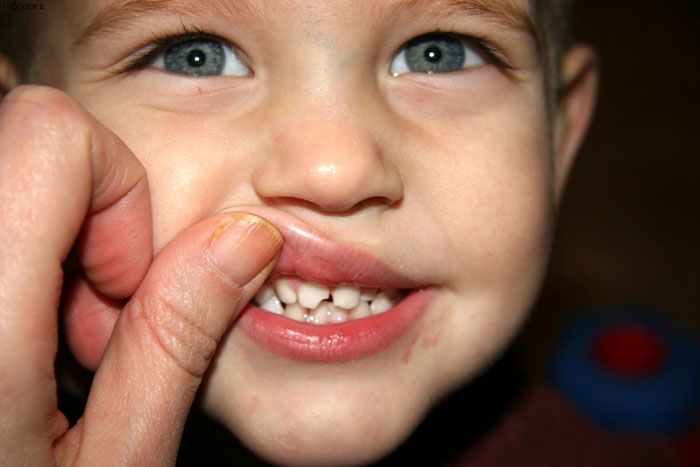Răng bị sứt mẻ do tình trạng nghiến răng kéo dài và nghiêm trọng