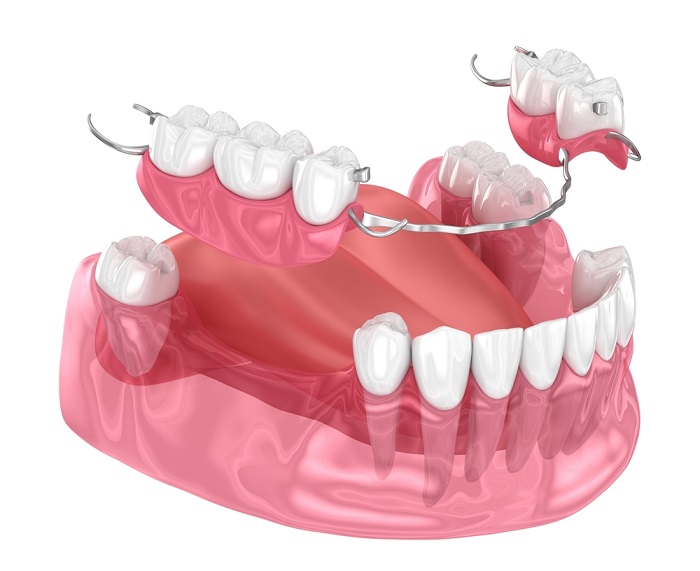 Trồng răng giả tháo lắp cho trường hợp mất răng hàm