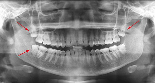 Răng khôn hàm trên mọc sai lệch đều được khuyến cáo nhổ bỏ