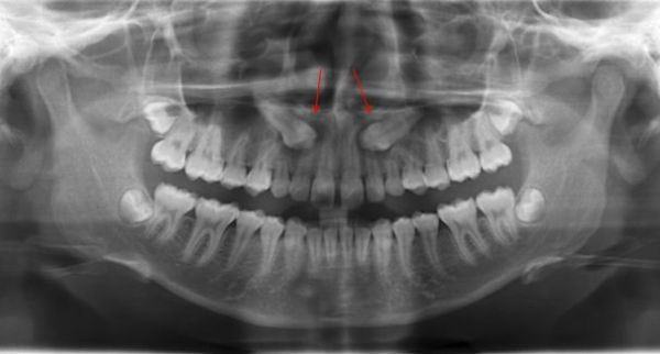 Răng mọc ngầm là chiếc răng nằm trong xương hàm không thể trồi lên khỏi nướu