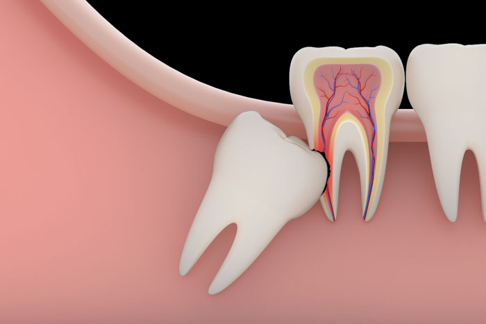 Răng số 7 có nguy cơ bị gãy rụng do răng khôn mọc đâm vào