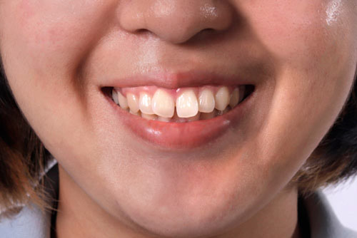 Răng sữa gãy rụng sớm do chấn thương làm tăng nguy cơ răng vĩnh viễn mọc lệch, khấp khểnh