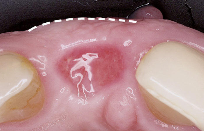 Sau 3 tháng nhổ răng là thời điểm khá thích hợp để đặt trụ Implant