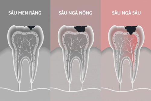 Sâu ngà răng diễn ra sau giai đoạn sâu men răng